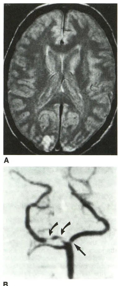 Fig. 1. A, Intermediate-weighted image demonstrates small bilateral occipital cortical infarcts
