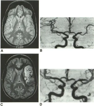 Fig. 3. A, obtained 6 hours after the onset Intermediate-weighted image of speech 