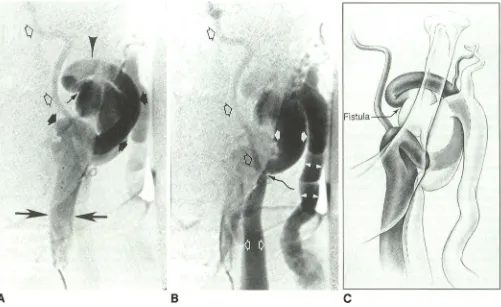 Fig. 1. (thin, normal enormously through flow Arteries are white arrows) Case 1. Preembolization frontal images of left common carotid digital subtraction angiography (A and B)