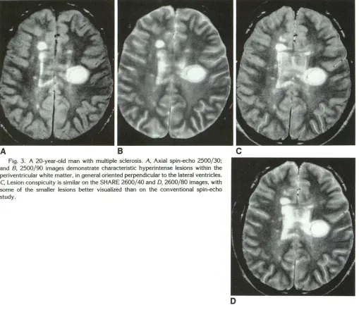 Fig. 3. A 20-year-old man and some periventricular white C, Lesion cwith multiple sclerosis