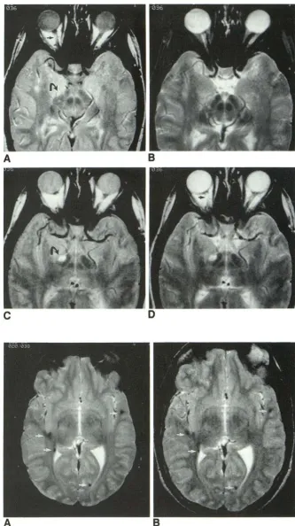 Fig. 4. A 28-yThe hyperintense and subclinical duncle lesion on C, tiple sclerosis. the SHARE fast spin-echo technique seen SHARE study SHARE images ear-old woman with mul-A, Axial spin-echo 2500/ 30 B, 2500/ 90 images do not show the optic nerve lesions a