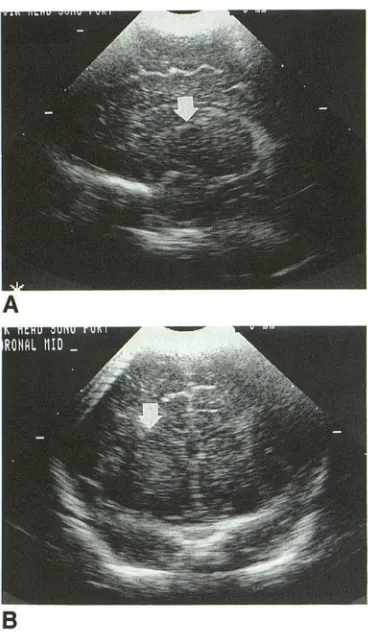 Fig. 4. Low-power of (large arrow) microphotograph of thalamus showing foci microcalcifications (small arrows) and perivascular edema in a neonate born to a cocaine-using mother