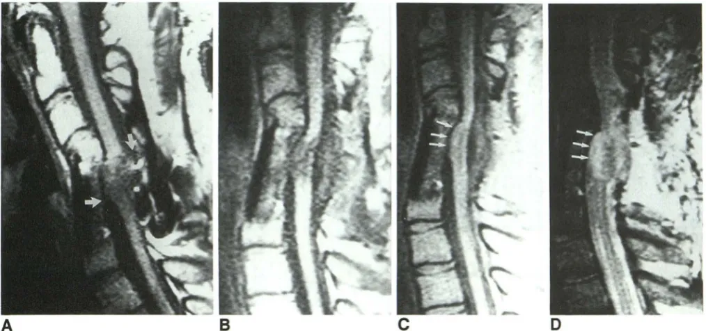 Fig. 1. cord and posterior tethering does ill C4-5 sagittal; defined. Note evidence Case 3