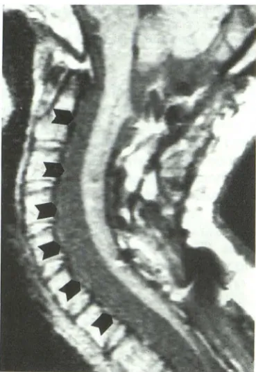 Fig. 2. Case 5. A , sabnodefecPPMM. Note evidence of priC, ubTlTl-weighted (600/ 20) m idline sagittal image