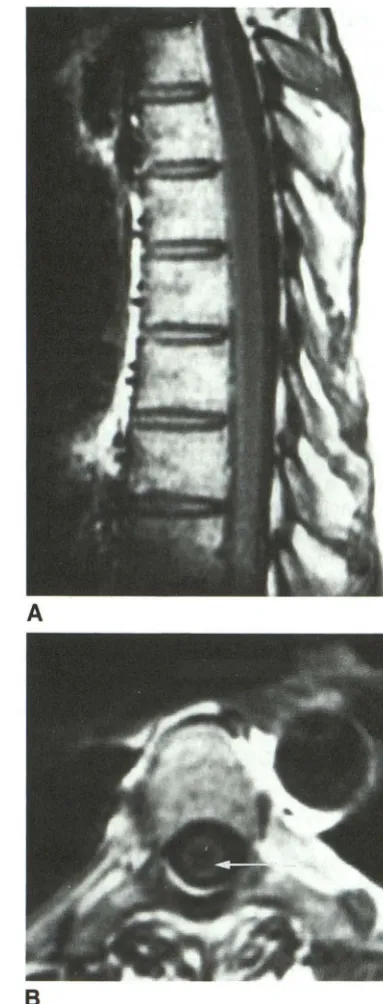 Fig. 6. Case 8. Initial injurdecreased signas septation 20) the cord is again seen which is fairly weintraoperative sonography, the MR findings could be interpreted intborder
