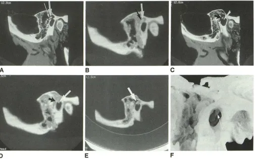 Fig. 1. Figures 2 and 3. resected area by manubrium of Thindicates the imaging. long process malleus