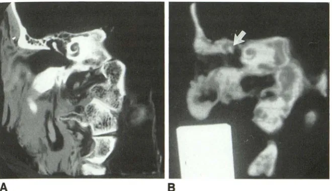 Fig. 2. A, correspond man cadaveric temporal bone specimen nubrium image has been photographed in reverse to used in Figure tomic Coronal CT image of left hu-1