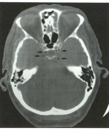Fig. 1. scan showed no change cavernous sinus right subclavian line. The contrast scan after this noncontrast Typical appearance of gas bubbles (arrows) in the in a patient with decreased mental status and a in the cavernous sinus gas