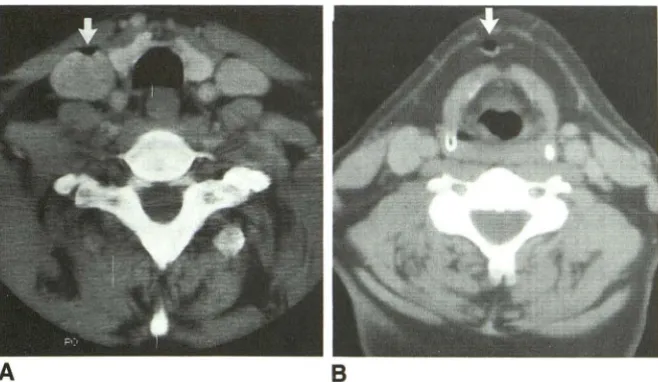 Fig. 4. Gaju(B) through a peripheral intravenous line started for this neck CT. The scan was performed gular vein s (arro ws) in the right internal (A) and in an anterior neck vein after the injection of intravenous contrast to evaluate a suspected neck ma