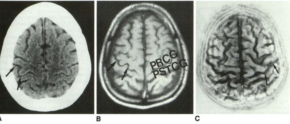 TABLE 1: Mean sensorimotor (22 cortex length in axial MR sections volunteers) 