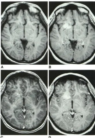 Fig. 6. Comparison exhibits although enhancement. Both sequences have the characteristic high signal the spin-echo sequence