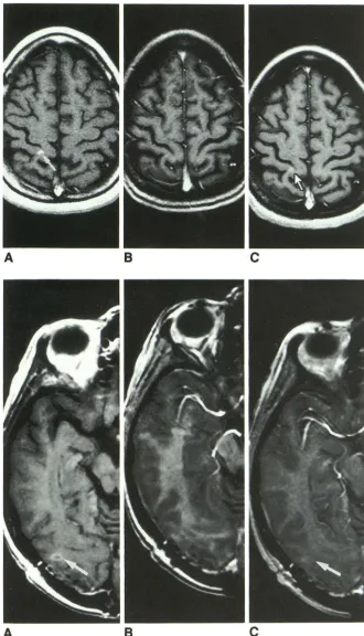 Fig. 7. In sequence (247 two than in the spin-echo imathe spin-echo sequence image (800/ 20) not not ment image has the greatest gray-white differen-rosis, the resented a lSPGR row, these sequences was the sulcal patternthis patient with multiple scle-3-D 