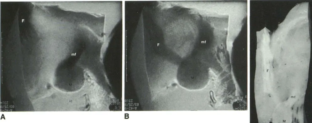 Fig. 1 . A cistern {ic), the hypothalamusand B, Parasagittal MR images and corresponding anatomic section (C) through the 