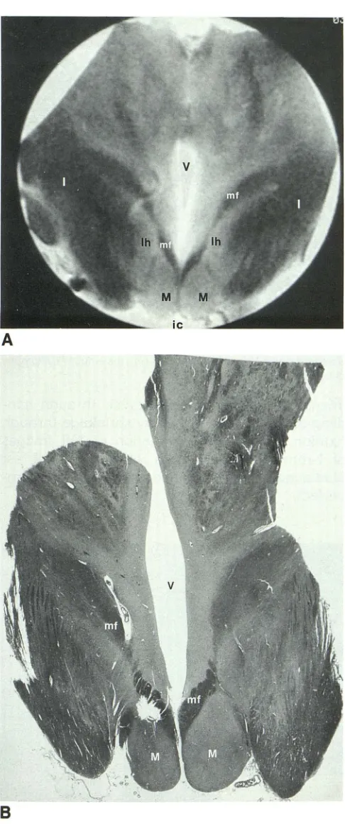 Fig. 3. A, mamillothalamic section ventricle void internal capsule (/), Coronal MR image and B, corresponding anatomic through the hypothalamus