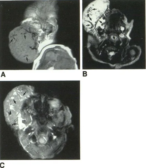 Fig. 1. a large cular flow signal voids isointense Barnes time/echo the arterial signal voids hemangiomapresaturation (B) 13, Six-month-old boy with head and neck proliferating 