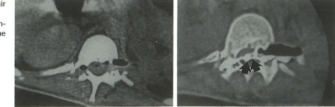 Fig. 3. Plain CT showing intraspinal air D,2. 