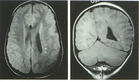 Fig. 6. erotopia the centrum semivale weighted (600/ 15) (B) spin-echo Axial proton density- (2500/ 15) (A) and coronal T1-MR images