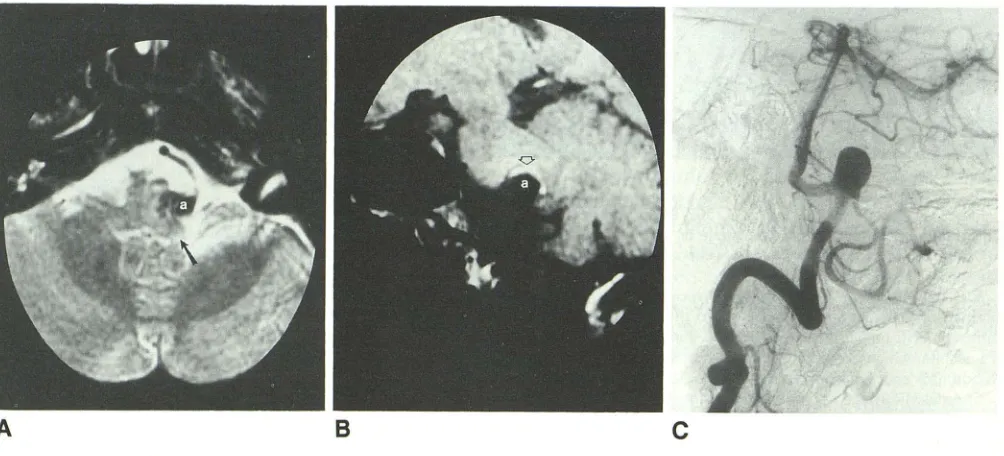 Fig. 4. reliable aberration and swelling the slightly Axial contrast-enhanced MR image (1.5 T, 567/ 20, 3-mm section thickness), patient four, subacute infarction (1)