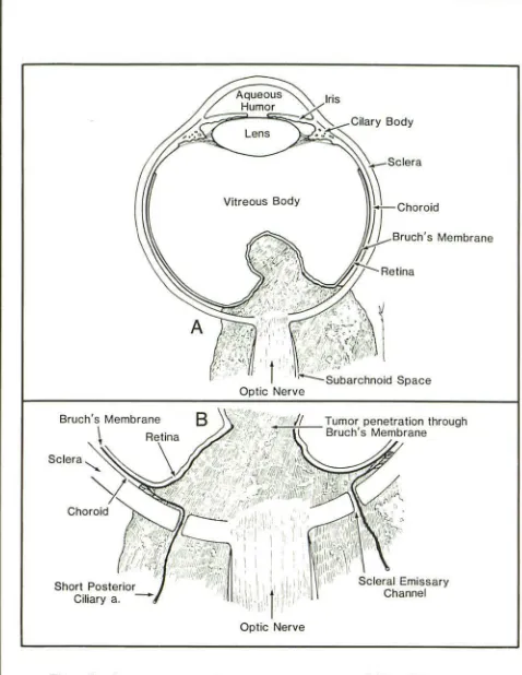Fig. 7. High-power S cells fusiform-melanoma, magnification demonstrates primarily shaped cells (curved arrow) characteristic of spindle-although several large pleomorphic epithelioid (outlined arrow) are also seen, indicating mixed mela-noma
