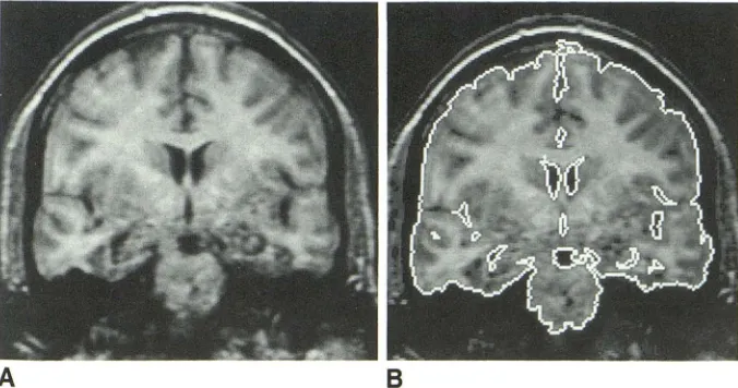 Fig. 3. A frusipulmercial SPGR sequence available GE in once the the same trwbrregions the ventrom icith ain is also ng se selected coronal image (A) a 3D set of a human brain obtained a customized, gradient-echo 3D sequence (equivalent to the com-from the