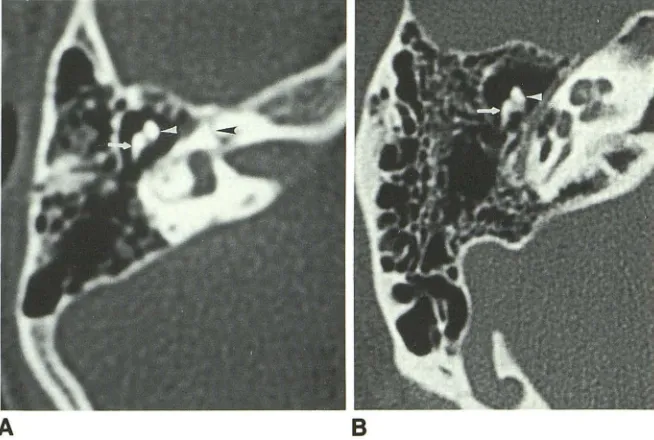 Fig. 1. nerve canal arrow), showing rowhead), Comparison of direct axial scans the head of the malleus (white ar-short process of the incus (white and labyrinthine portion of the facial (black arrowhead)