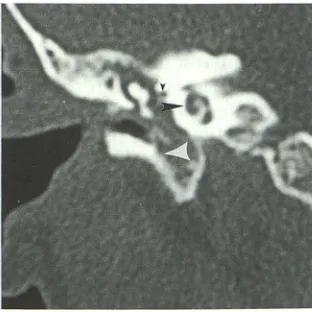Fig. 2. Comparison of scans displaying the head direct coronal of the malleus 