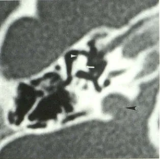Fig. 5. Submillimeter data. canal and = section thickness) reconstructions (malleus white arrowhead, (1.0-mm effective incus = white arrow, labyrinthine portion of the facial nerve = black arrowhead) from axial spiral A, Coronal