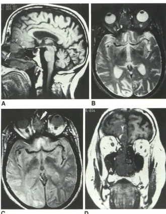 TABLE 1: Clinical information in five patients with olfactory neuroblastoma 