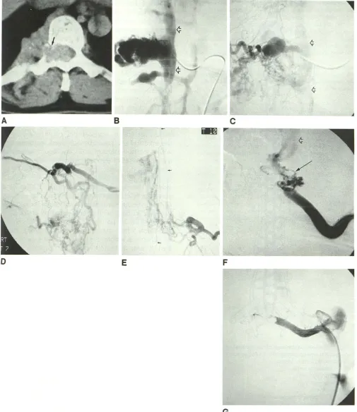 Fig. 2. Patient 2. Axial CT at T9 