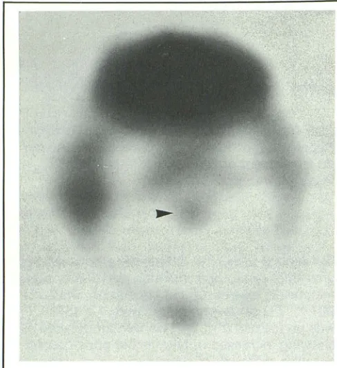 Fig. 2. Axial 8 region months 20 1Tl -SPECT image through the brain stem after initial therapy reveals increased uptake in the of the pons (arrowhead), consistent with regrowth of tumor