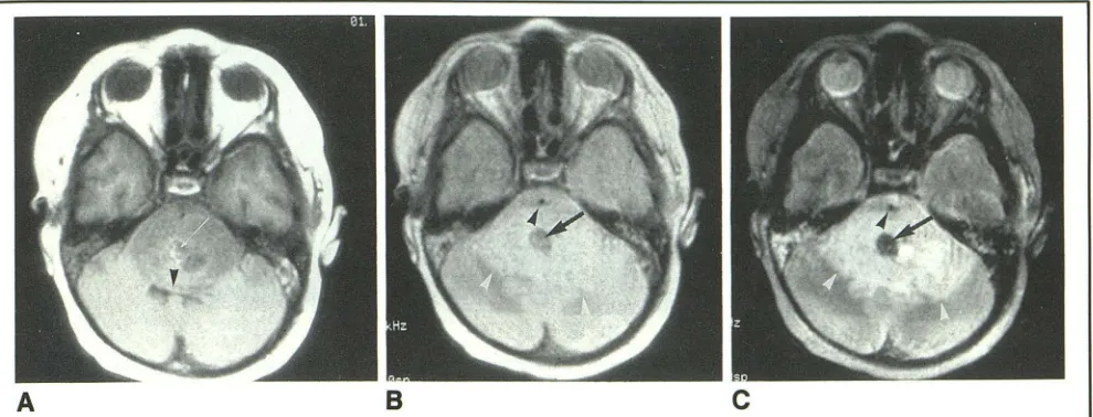 Fig. 3. A, on surrounding area 30)-weighted image the with early pons the fourth ventricle MR axial T1-weighted image (spin echo (SE) 600/27) 1 day before the patient's death demonstrates low signal in pons with central focal hyperintense signal (small whi