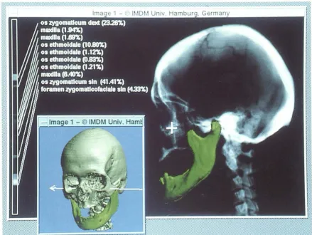 Fig. 7. Artificial (icon this instance, the mandible) can be added mponents x-ray image (topogram) produced from the CT model