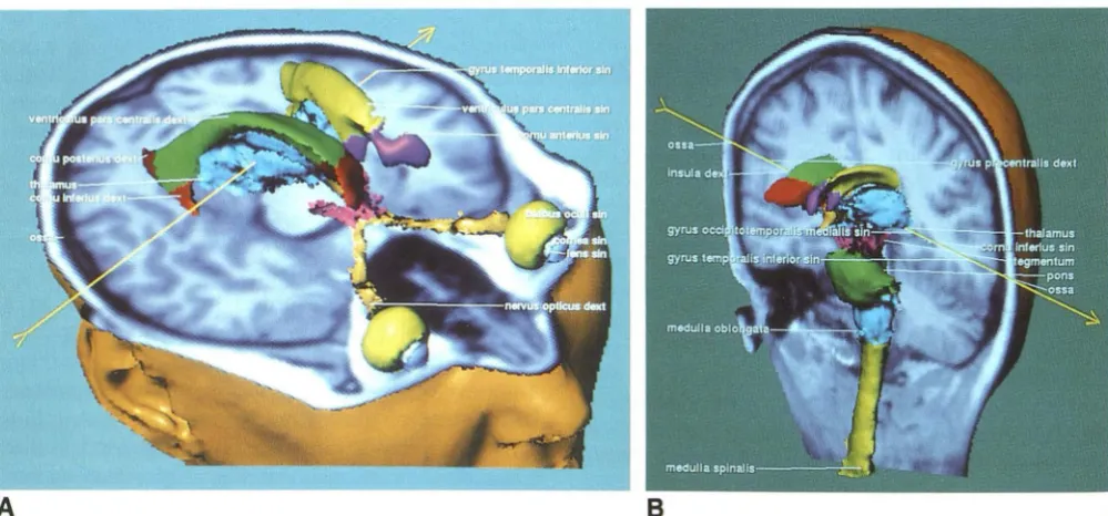 Fig. 8. Simulation of craniotomy. Layers can be removed successively and information queried about the encountered objects