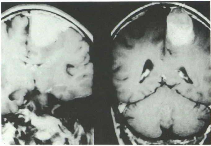 Fig. 3. Coronal Tlembolization (B), and 3 days conv -weighted gadolinium-enhanced MR, case 5, before embolization of the meningioma (A), 3 hours after the after the embolization (C)