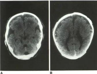Fig. 1. subarachnoid spaces Moderate enlargement of the anterior interhemispheric fissure and base of the sylvian fissures with no enlargement of over the frontal convexities