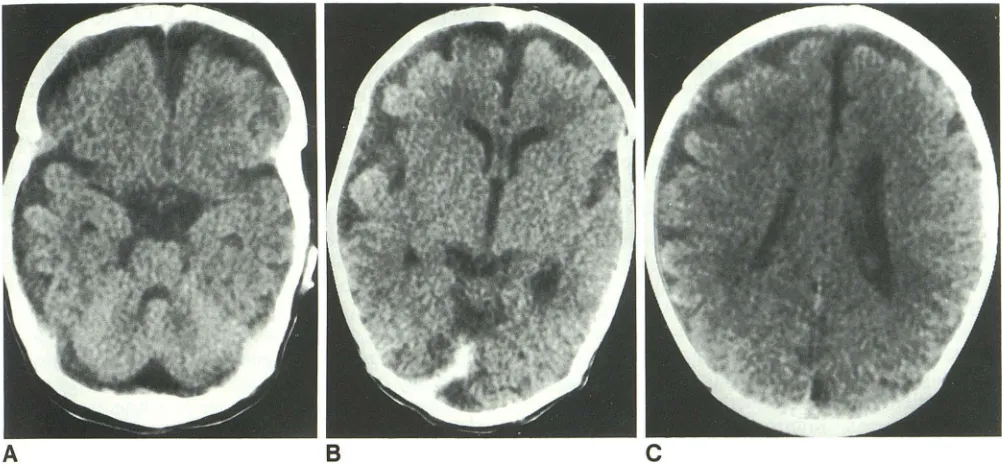 Fig. 4. Mild Attenuation enlargement of subarachnoid spaces, asymmetrically prominent over the right frontal and right temporal lobes