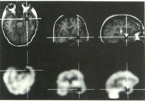 Fig. 3. An (white causes clear photopenic interictal scan in which a temporal lobe tumor temporal lobe seizure activity