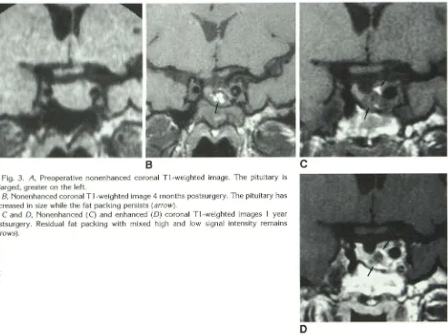 Fig. 3. A, Preoperative nonenhanced coronal Tl-weighted image. The pituitary is 