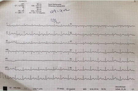 Figure 2: Normal ECG of the patient after treatment. 