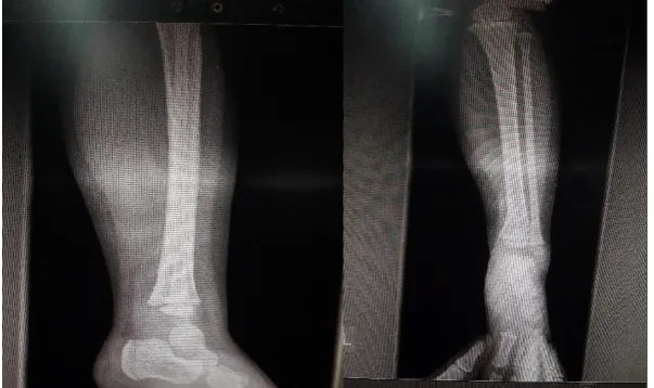 Figure 3: AP and lateral X-ray, 12 months after the treatment, showing the replacement of the osteolytic lesion with the restoration  of the cortical contours  