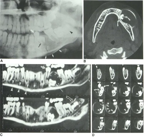 Fig. 1. (small developing delineated within buccal arrow) Superimpostion D, B, A, Calcifying odontogenic cyst