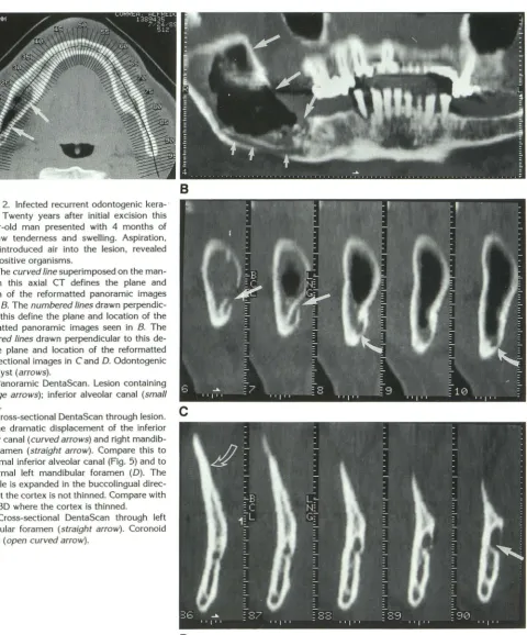 Fig. 52-year-old man presented gram positive organisms. which introduced air right jaw tenderness and swelling