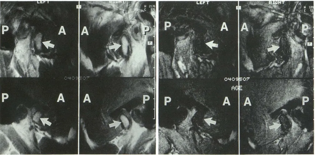 Fig. 3. A set marrow normally four of closed-mouth images in a normal patient study. Four T1-weighted (350/ 28/ 1) images are shown on the left and AGE (350/ 40/ 1) images on the right, each presented as two adjacent sections from each side of the patient