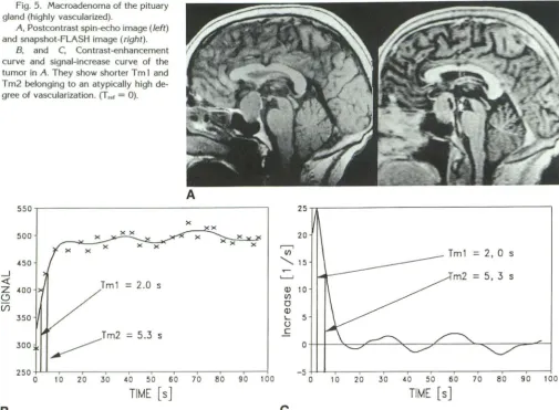 Fig. 5. Macroadenoma of the pituary gland (highly vascularized). 