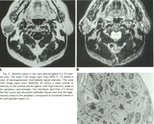 Fig. 2. Warthin intold T2W that the subcapsular region the intensity mass ensity areas in tumor in the right parotid gland of a 70-year-man