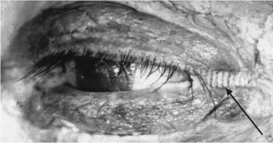 Figure 4. The clamp is removed leaving an impression in the soft tissue.