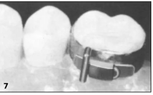 Figure 9: Cast with Unitek™ MIA Transfer Angle and auxiliary sheath representing the precise lingual sheath position in the mouth.