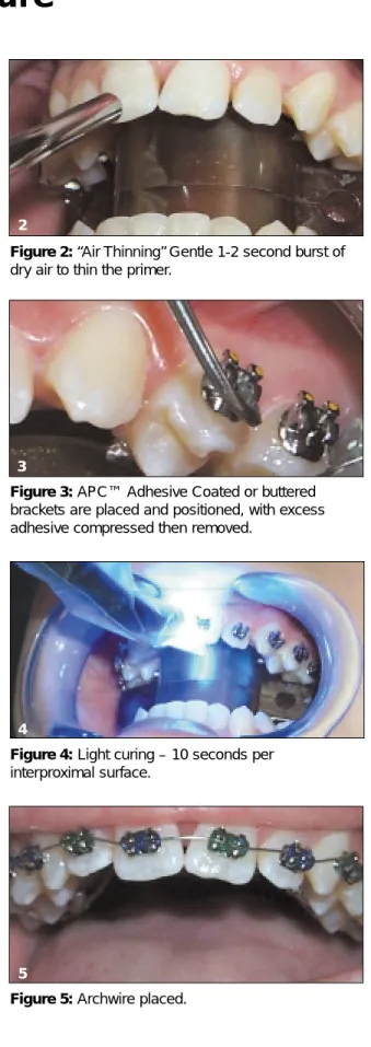 Figure 1: Transbond™ Plus Self Etching Primer is applied after pumiced teeth are rinsed and dried  (swirl for 3 seconds per tooth).