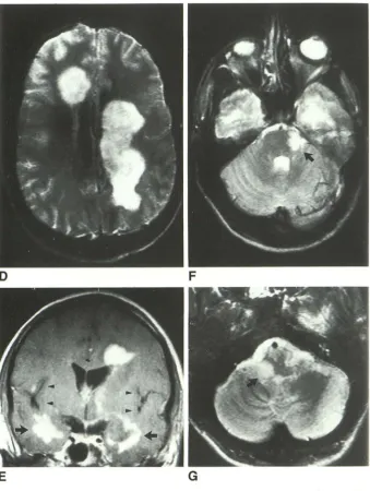 Fig. 2. cl80. T22A-2C riees tal and right -Continued. 0 , Axial 2500/ WJ image above the lateral ventri-obtained at the same time as Figures indicates large confluent left pa-frontal plaques
