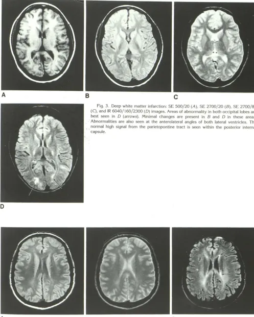 Fig. (C), and 3. Deep white matter infarction: SE 500/20 (A), SE 2700/ 20 (B), SE 2700/80 IR 6040/ 160/2300 (D) images